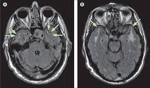 Virtueel brein van hersentumorpatiënt verbetert operatie.